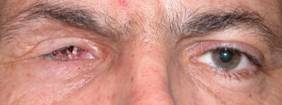 Anophthalmic cavity 1
