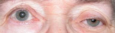 Anophthalmic cavity 19