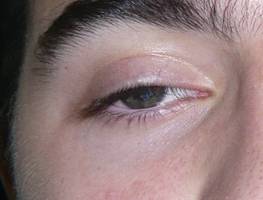 Anophthalmic cavity 20