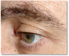 Dermatochalasis 1