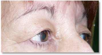 Dermatochalasis 2