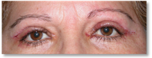 Dermatochalasis 8