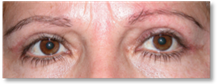 Dermatochalasis 9