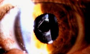 Cataracts 10