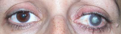 Enucleation Evisceration  Exenteration 1