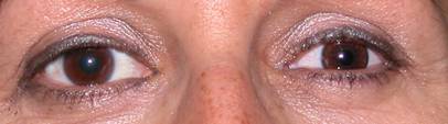 Enucleation Evisceration  Exenteration 2