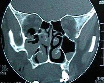 Orbital fractures 1