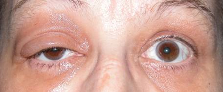 Orbital inflammation 2