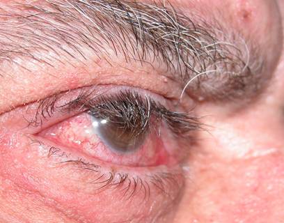 Eyelid hyperlaxity 3