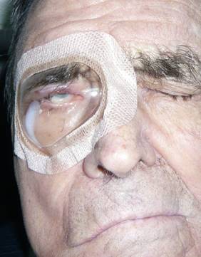 Facial paralysis2
