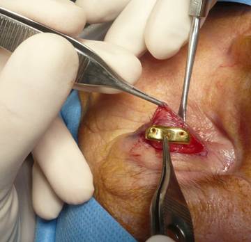 Facial paralysis3