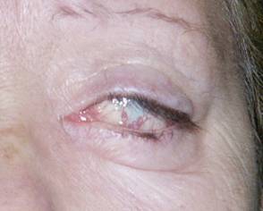 Facial paralysis4