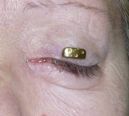 Facial paralysis5
