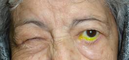 Facial paralysis6