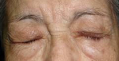 Facial paralysis7