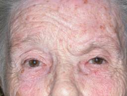 Facial paralysis9