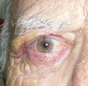 Facial paralysis11