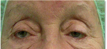 Blepharoplasty 14