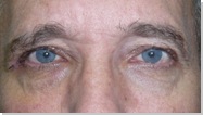 Eyelid ptosis 13