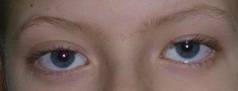 Eyelid retraction 1