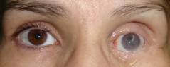 Eyelid retraction 5