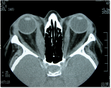 Thyroid 10