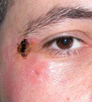 Eyelid trauma 1
