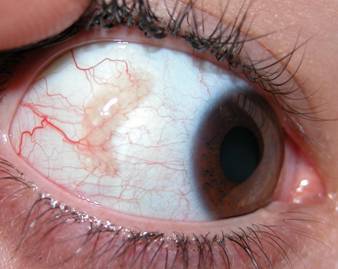 Conjunctival tumors 4