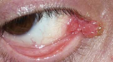 Conjunctival tumors 6