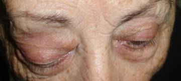Orbital tumours 3