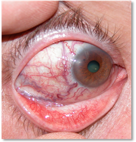Orbital tumours 5
