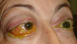 Orbital tumours 13