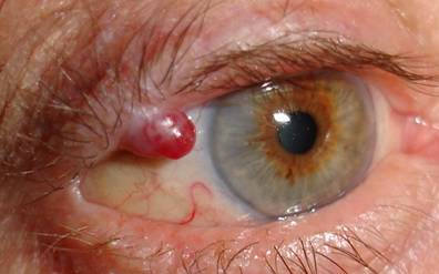 Eyelid Tumours 1