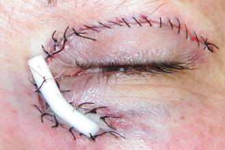 Eyelid Tumours 10