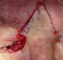 Eyelid Tumours 13