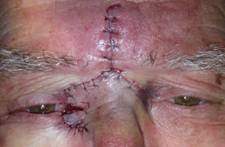 Eyelid Tumours 15