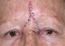 Eyelid Tumours 17