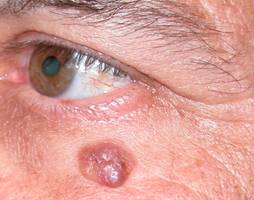 Eyelid Tumours 19