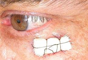 Eyelid Tumours 22