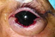 Eyelid Tumours 29