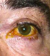 Eyelid Tumours 31