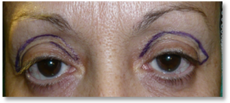 Dermatocalasia 3