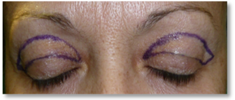 Dermatocalasia 4