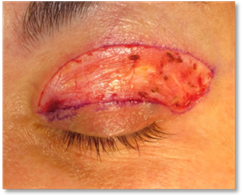 Dermatocalasia 5