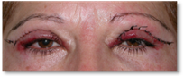 Dermatocalasia 7