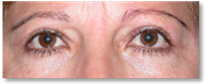 Dermatocalasia 10