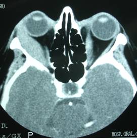 Inflamaciones Orbitarias 15