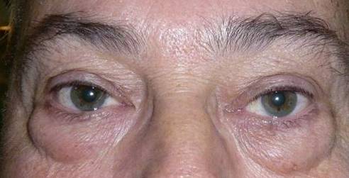 Blefaroplastia 1