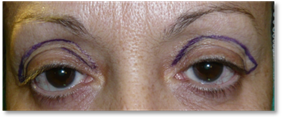 Blefaroplastia 3