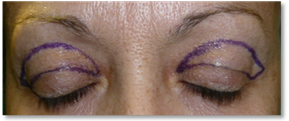 Blefaroplastia 4